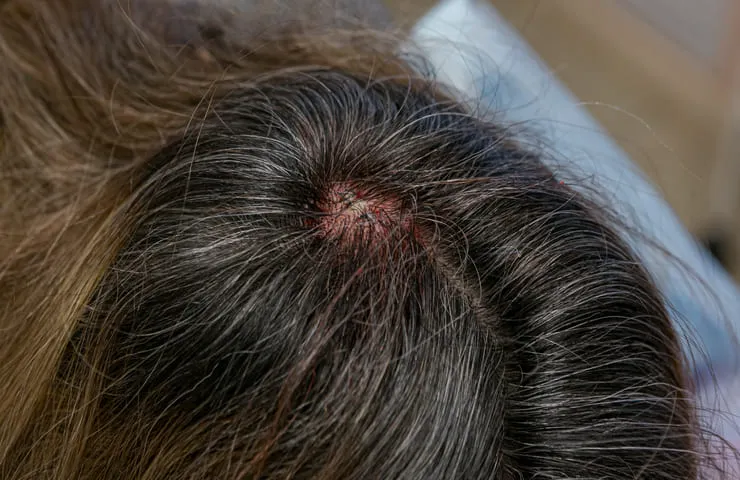 Follikulitis Haaransatz