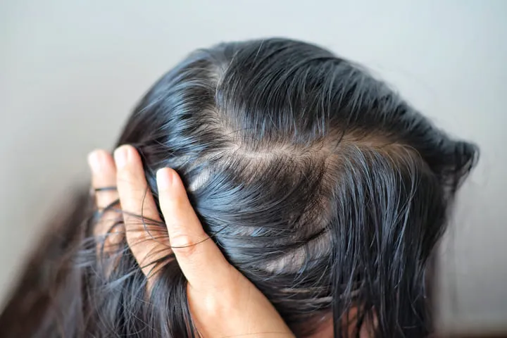 Anfangender Haarausfall Frauen