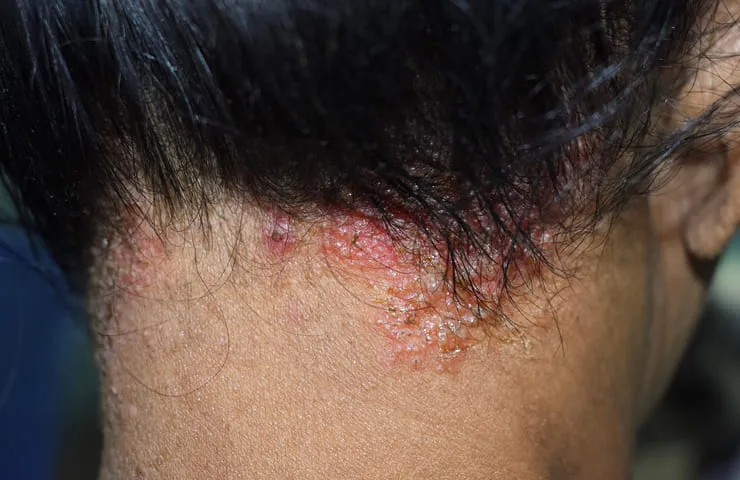 Extreme Ringelflechte am Nacken durch Therapie